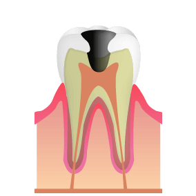 歯髄に達したむし歯