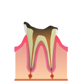 歯間部が崩壊した残根状態のむし歯